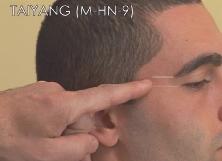 Taiyang- agopuntura Mal di testa