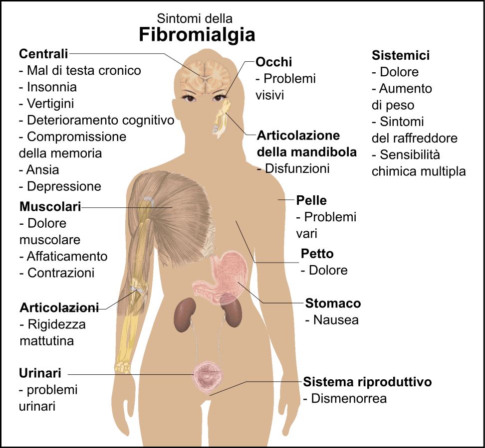 sintomi fibromialgia