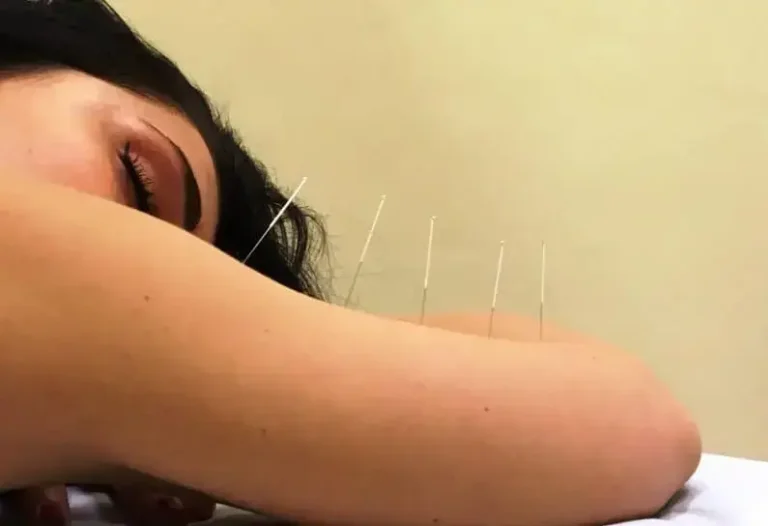 Una paziente durante una visita di agopuntura a Rimini si rilassa dopo che le sono stati applicati alcuni aghi per agopuntura dalla dott.ssa Erika Francese